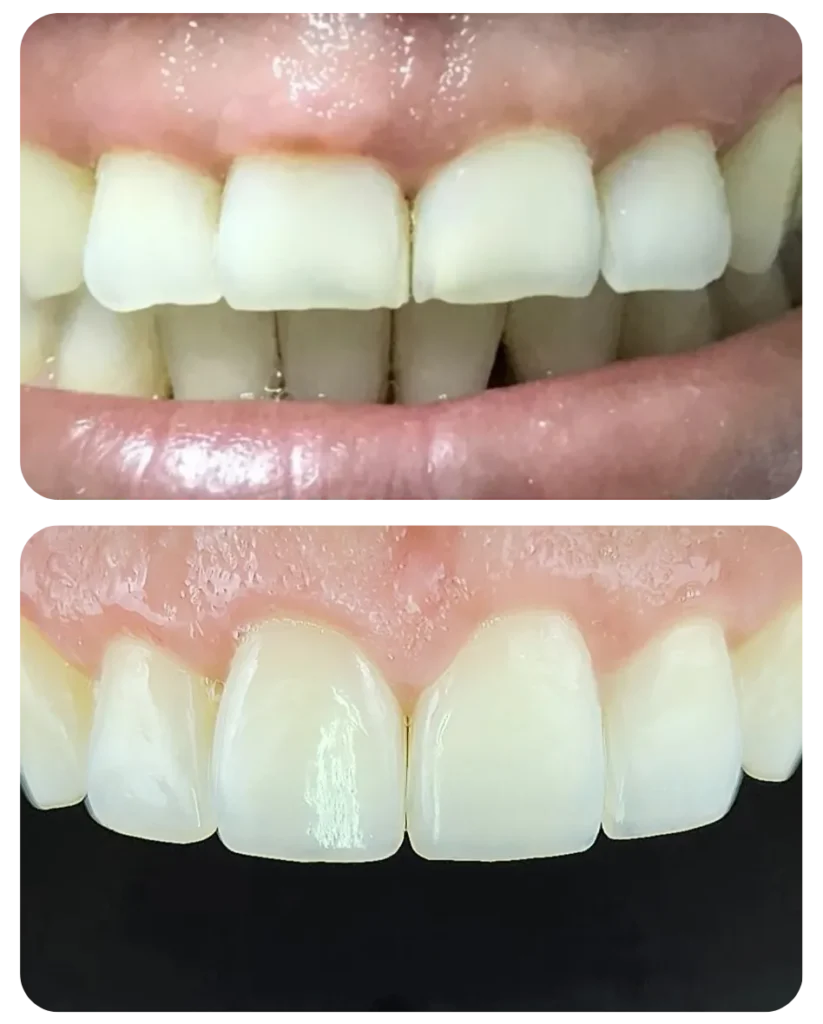 Correção do dente curto (excesso de gengiva) e desgastes nas pontas.