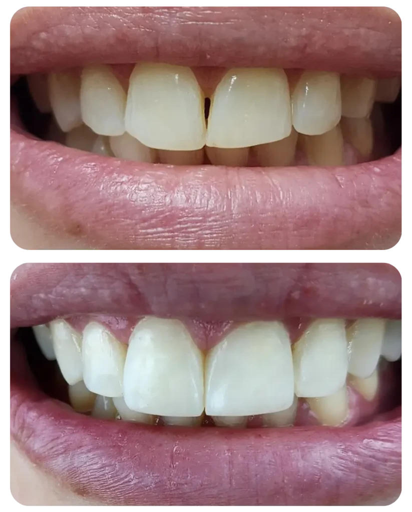 Fechamento do espaço escurecido entre os dentes e correção do tamanho.