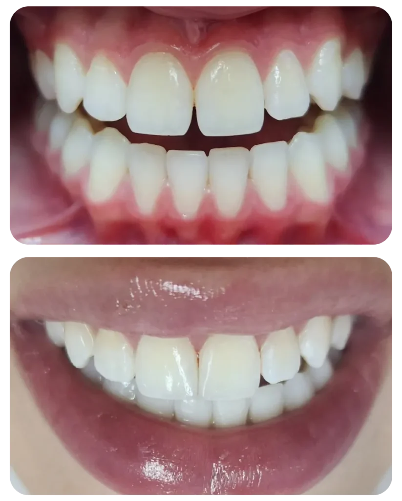 Paciente não estava contente com seus dentes. Correção da cor e formato.