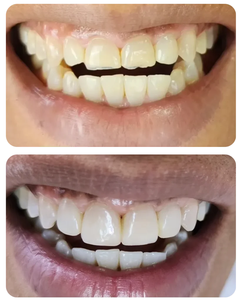 Correção do tamanho, cor e formato dos dentes desgastados pelo bruxismo.