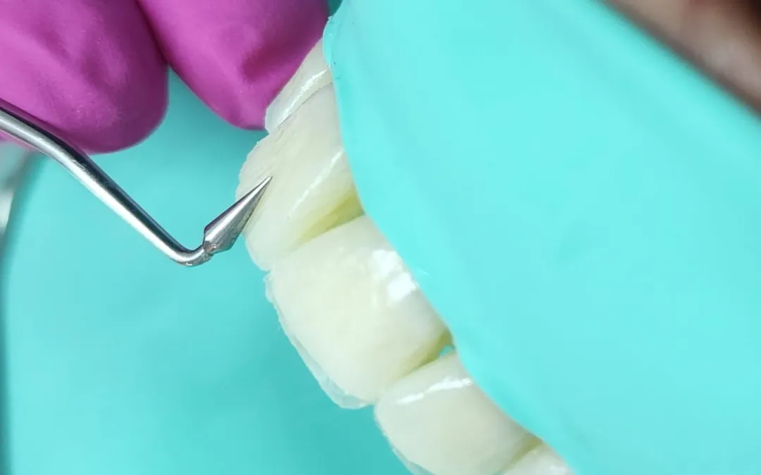 Construção do Novo Sorriso Facetas em Resina Dra Lígia Spada