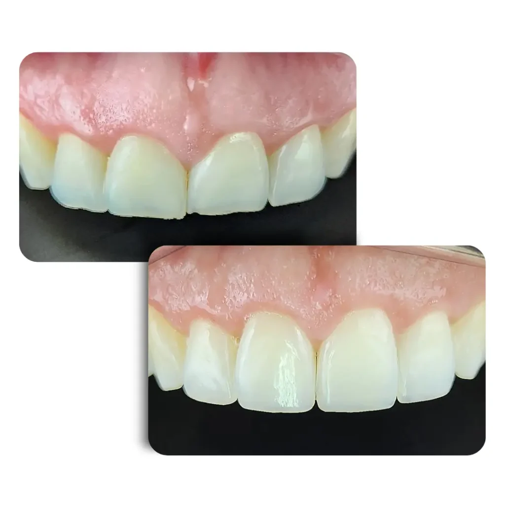 Faceta em Resina Dra Lígia Spada Santa Bárbara DOeste - branco 2