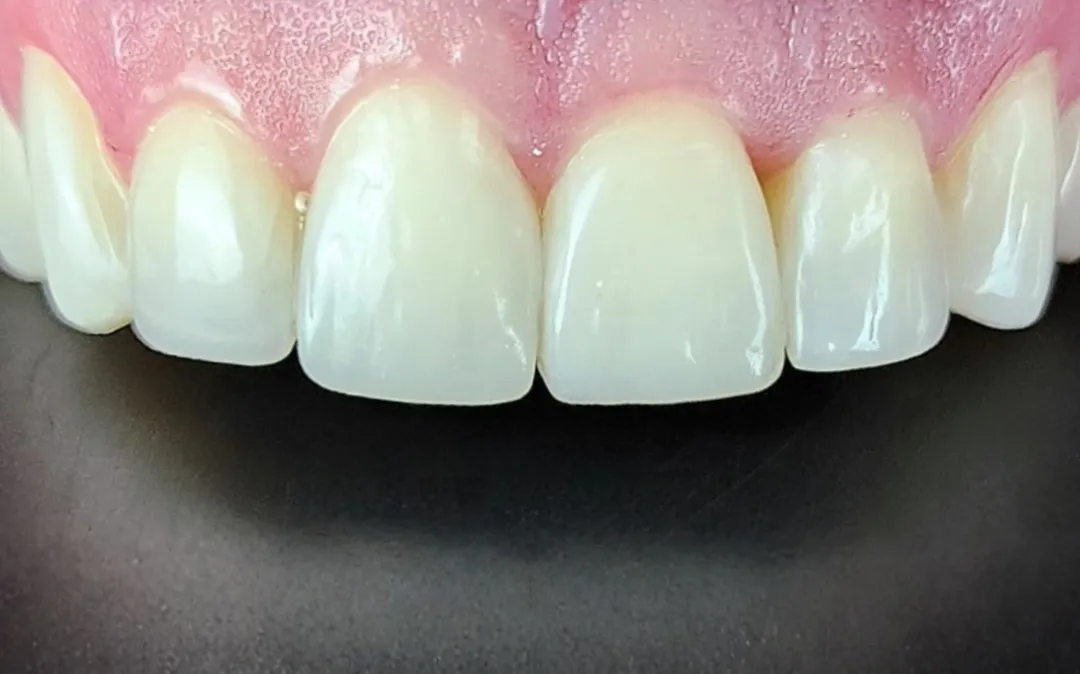 Finalização de Faceta em Resina Dra Lígia Spada