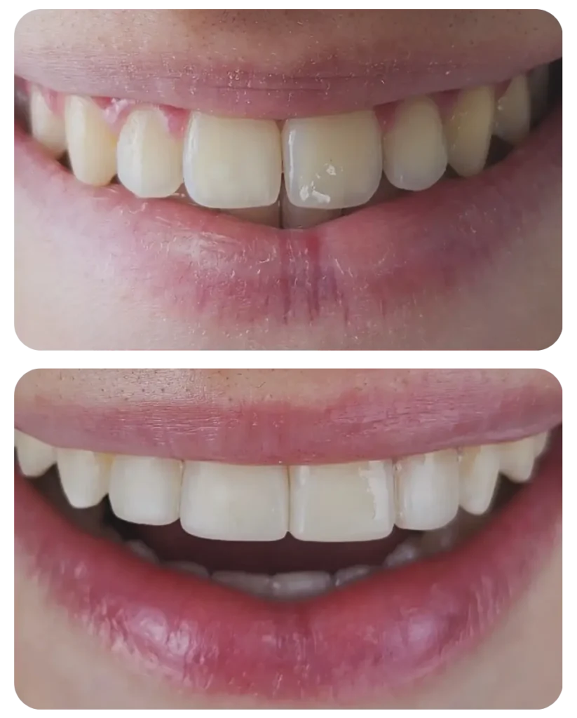 Paciente não gostava do formato dos dentes. Correção da cor e formato.