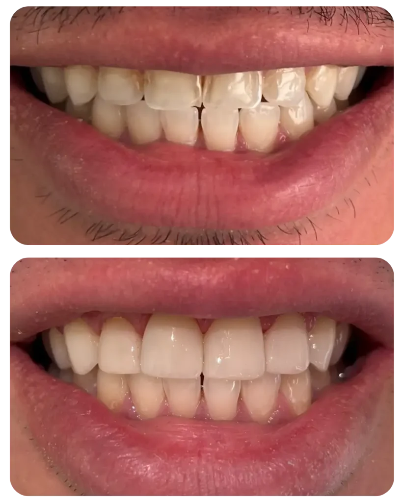 Mesmo caso da imagem à esquerda. Correção da cor, espessura e formato.