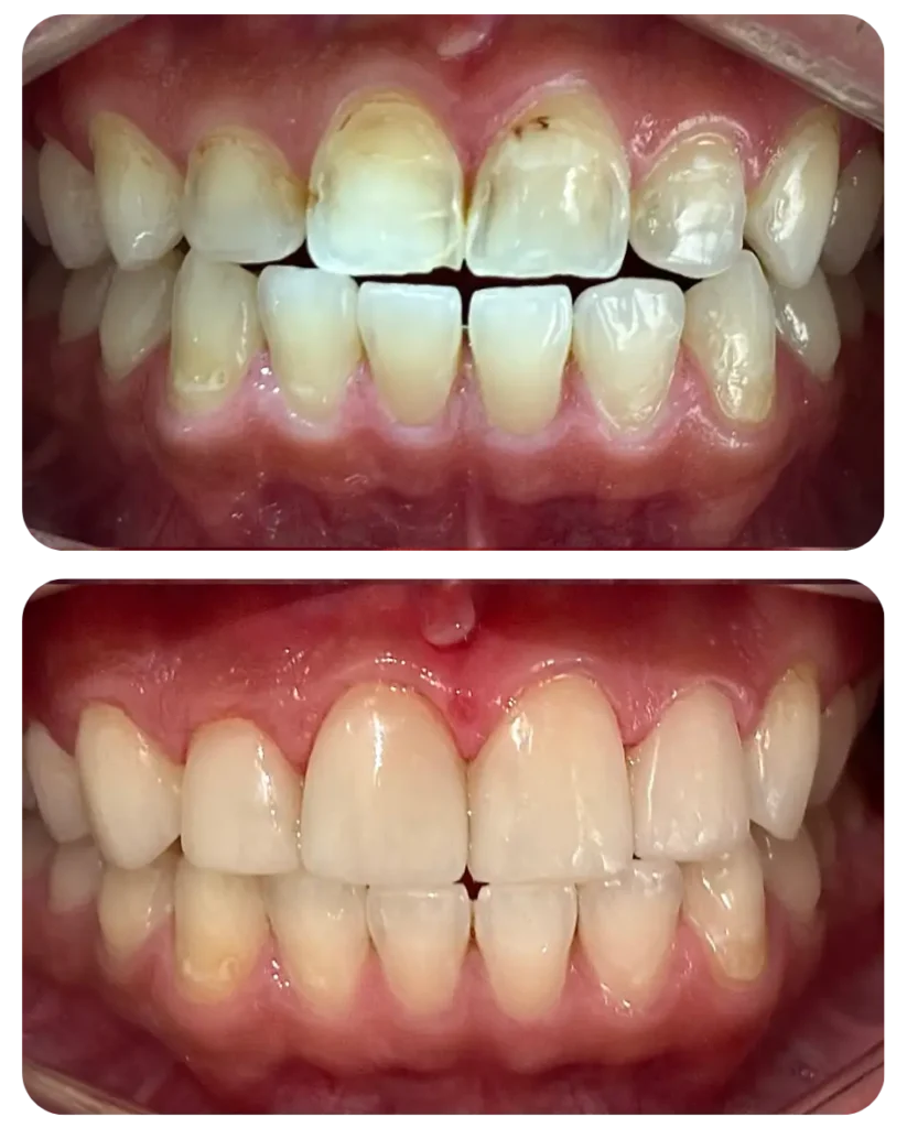 Defeito na formação do esmalte do dente (manchas e irregularidades).