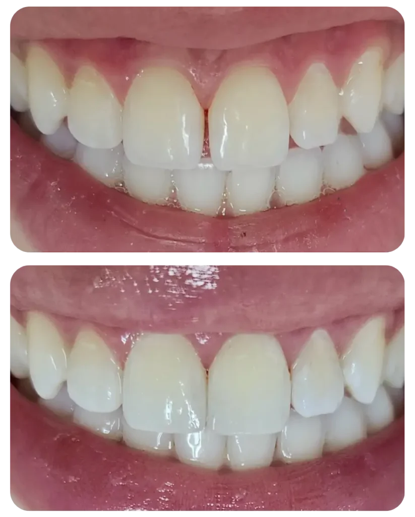 Fechamento do espaço entre os dentes (conhecido como diastema).
