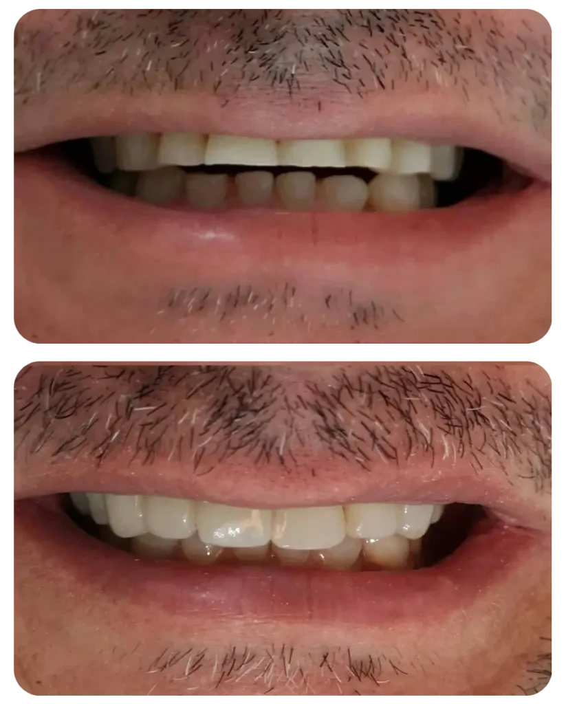 Correção dos dentes curtos desgastados pelo bruxismo.