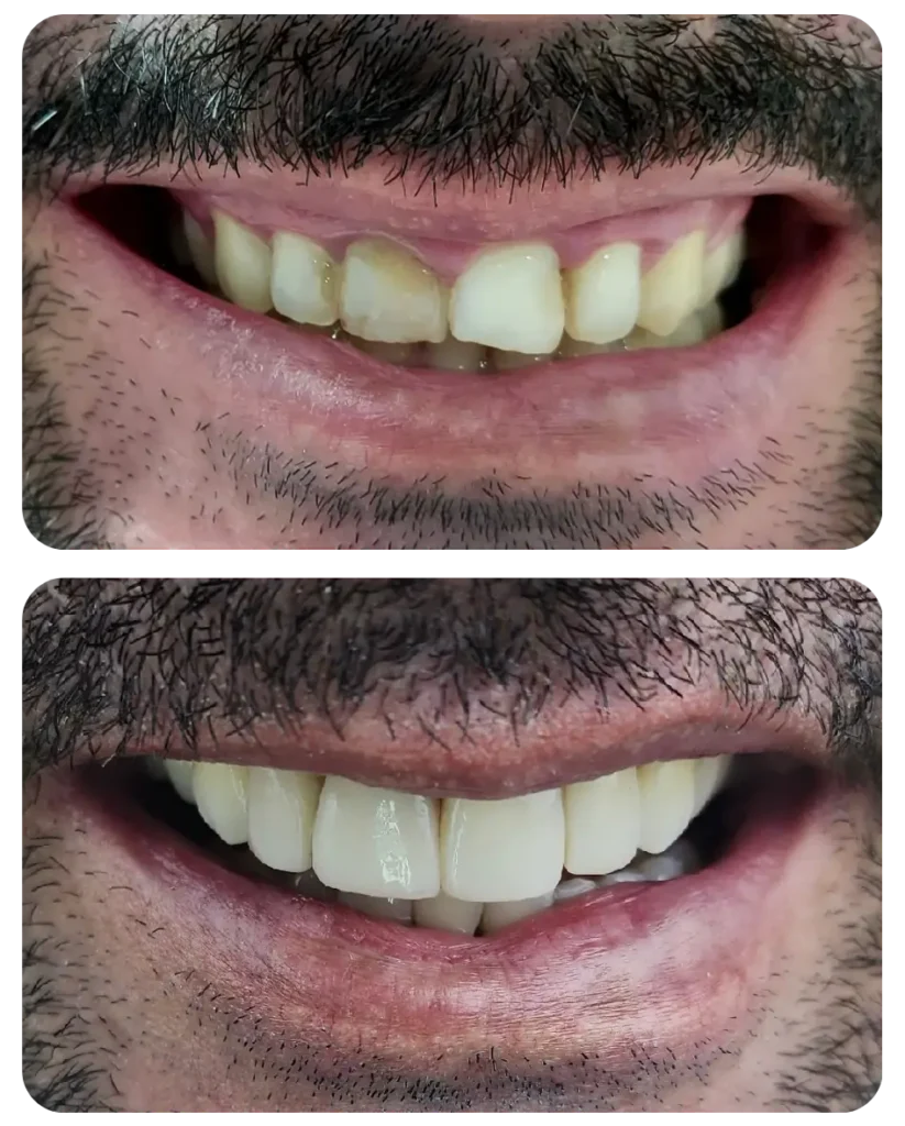 Restaurações antigas amareladas e dentes amarelados.